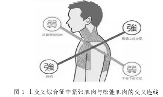 图 1 上交叉综合征中紧张肌肉与松弛肌肉的交叉连线