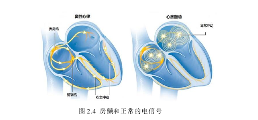 图 2.4  房颤和正常的电信号 