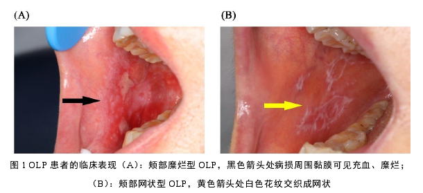 图 1 OLP 患者的临床表现（A）：颊部糜烂型 OLP，黑色箭头处病损周围黏膜可见充血、糜烂；（B）：颊部网状型 OLP，黄色箭头处白色花纹交织成网状